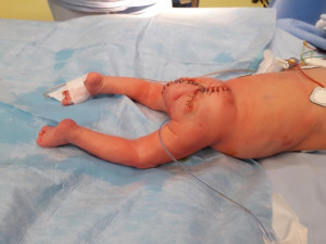 Lékaři z Podolí zachránili život nenarozené holčičce. Operovali ji v děloze její maminky