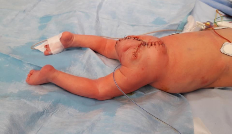 Holčička je po náročné operaci v pořádku