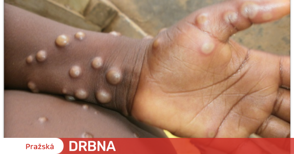 Les experts en hygiène de Prague ont confirmé trois autres cas de monkeypox.  Il y a un total de trente |  Santé |  Nouvelles |  Potins de Prague