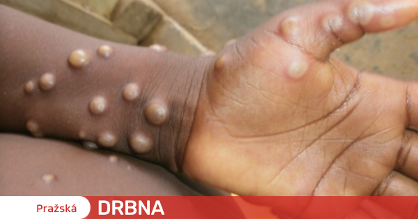 Hygiene experts in Prague have confirmed three more cases of monkeypox.  There are a total of thirty |  Health |  News |  Prague Gossip