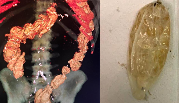 Muž měl v těle 19 kapslí s kokainem.