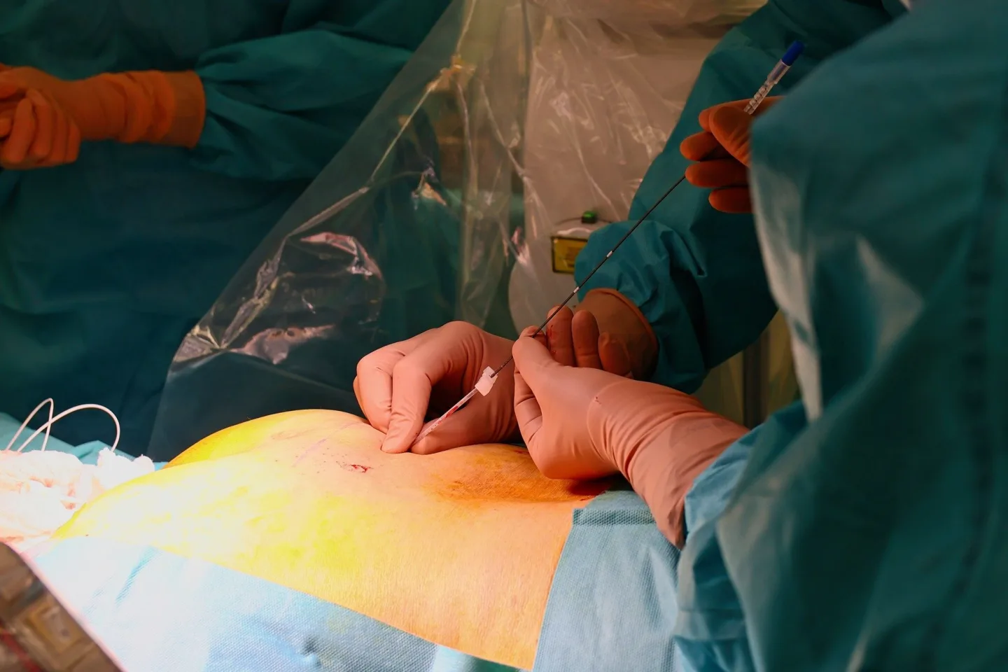 Na Bulovce léčí inkontinenci přelomovou metodou, pomůže chytré zařízení pod kůží